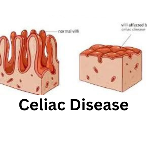 30 MINUTE CELIAC DISEASE CONSULTATION