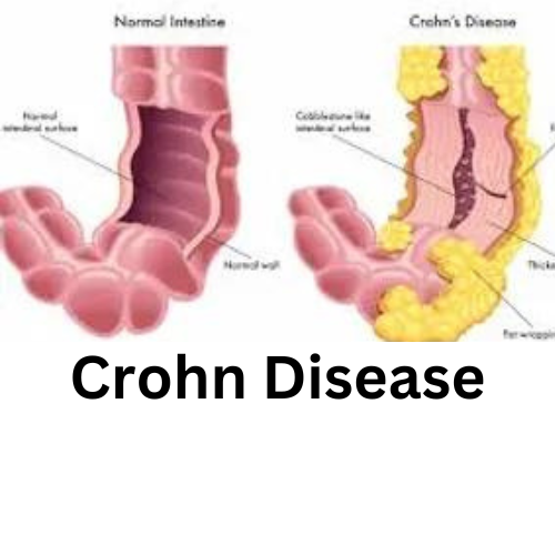 30 MINUTE CROHN DISEASE CONSULTATION